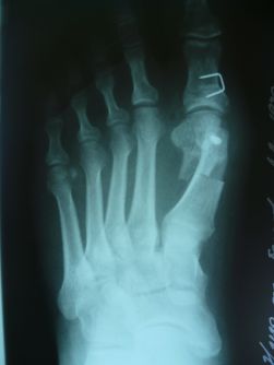 Артрозный hallus valgus